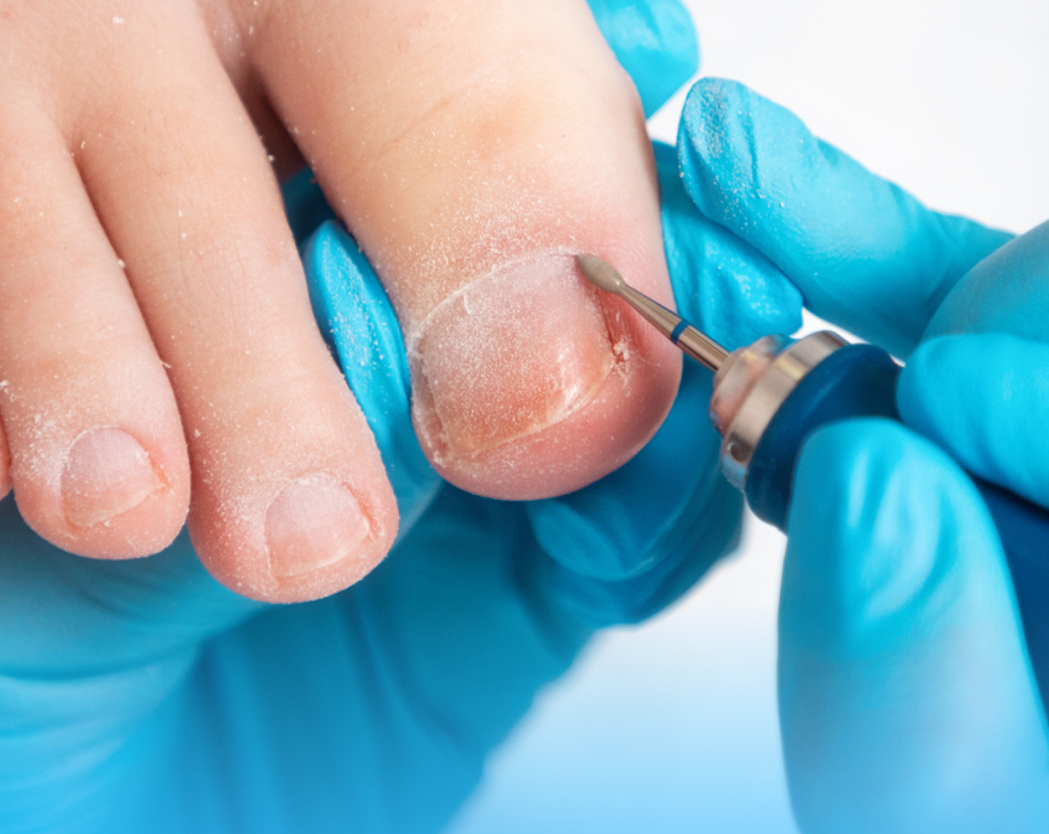 Ingrown Toenail