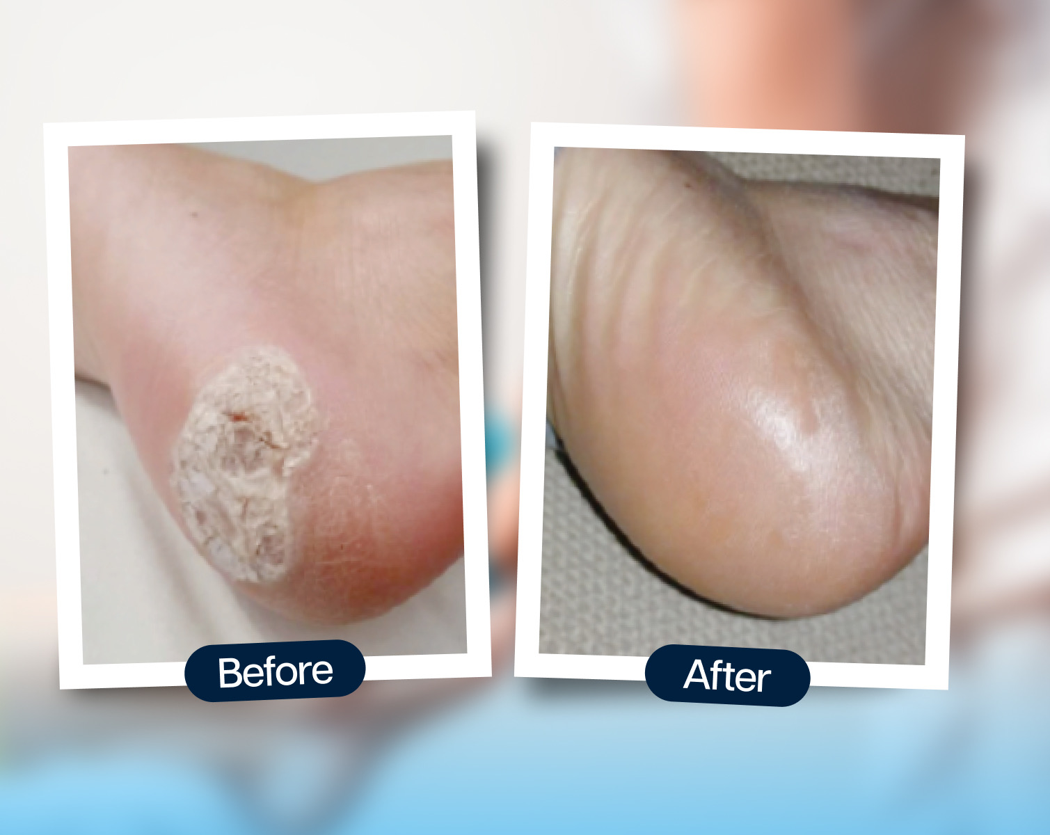 Swift Wart Removal
