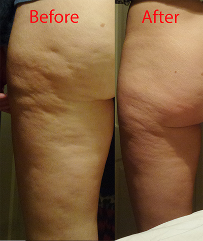 Cellulite Therapy