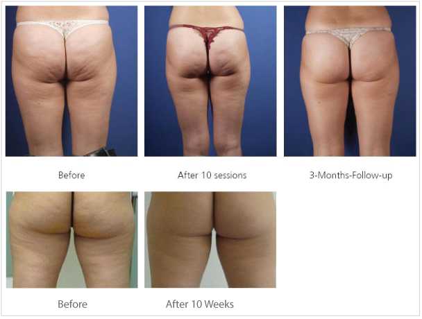 Cellulite Therapy
