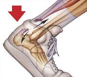 Achilles Tendonitis Treatment