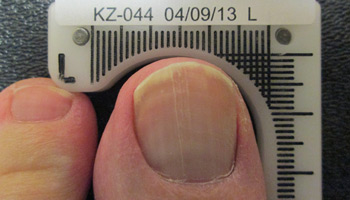 Cold Laser Therapy for Fungal Nail Infections