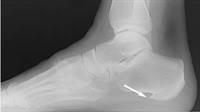 Heel Pain Treatment