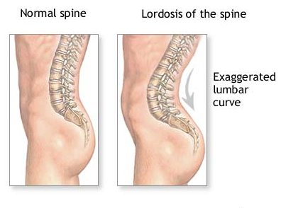 Illustration of the excessive inward spinal curve seen in lordosis