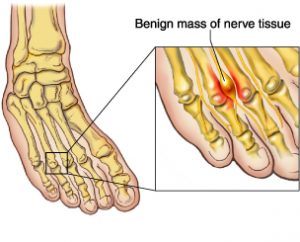 Morton’s Neuroma Treatment