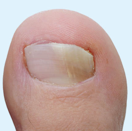 Cold Laser Therapy for Fungal Nail Infections