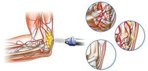 Shockwave Therapy for Foot, Knee & Leg Pain
