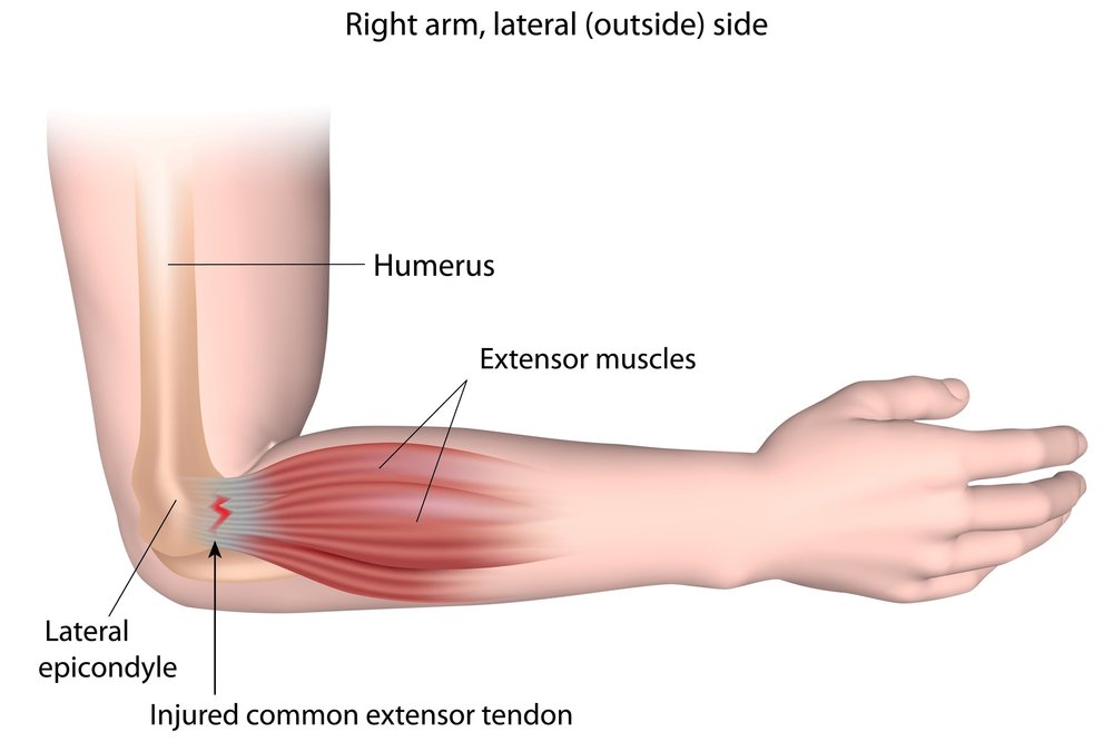 Tennis elbow — lateral epicondyle of the elbow